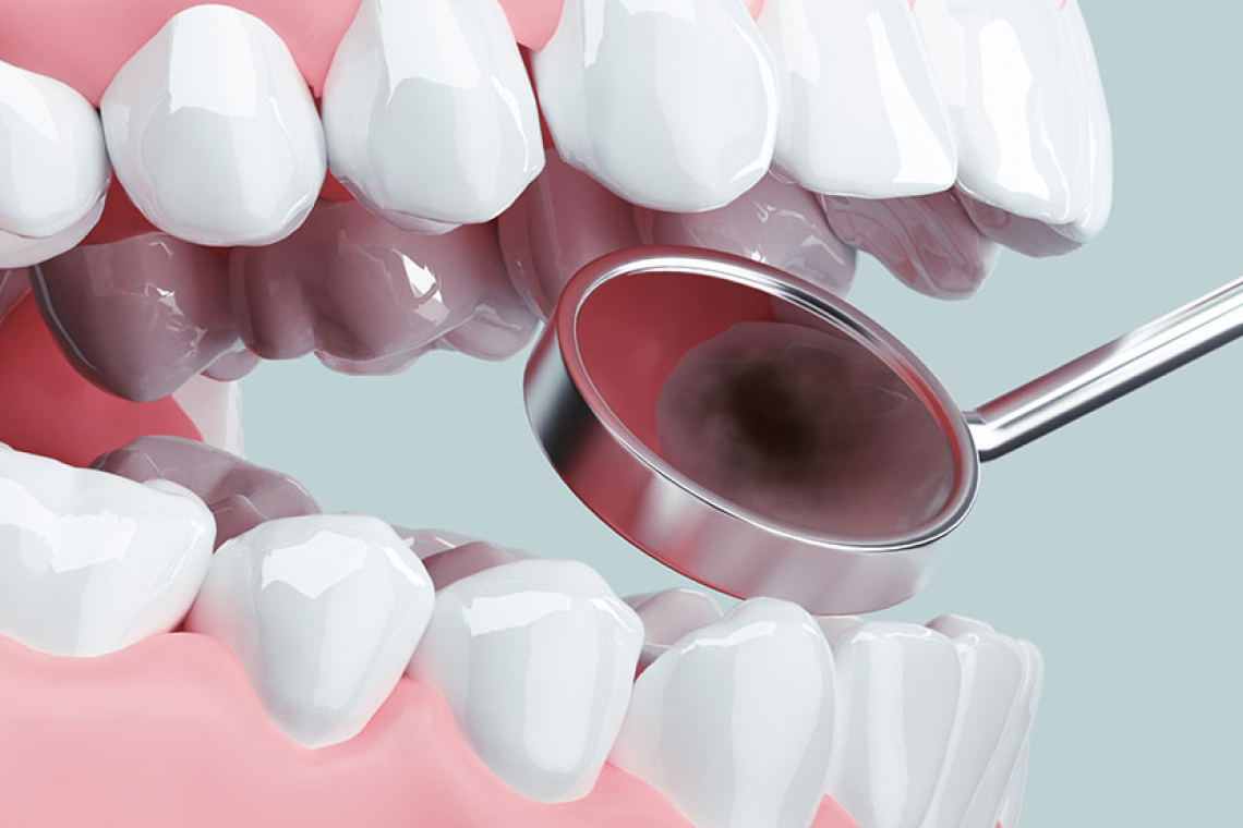 できる限り歯を残すための予防の意識